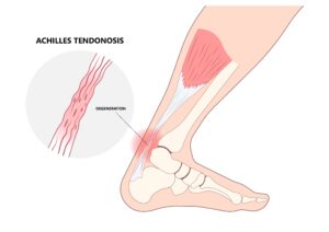 Peroneal Tendonosis: Why